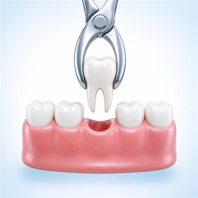 Procedimiento de extracción dental simple