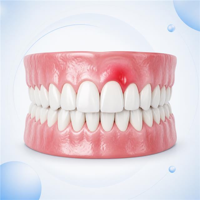 Inflamación asociada a una infección dental