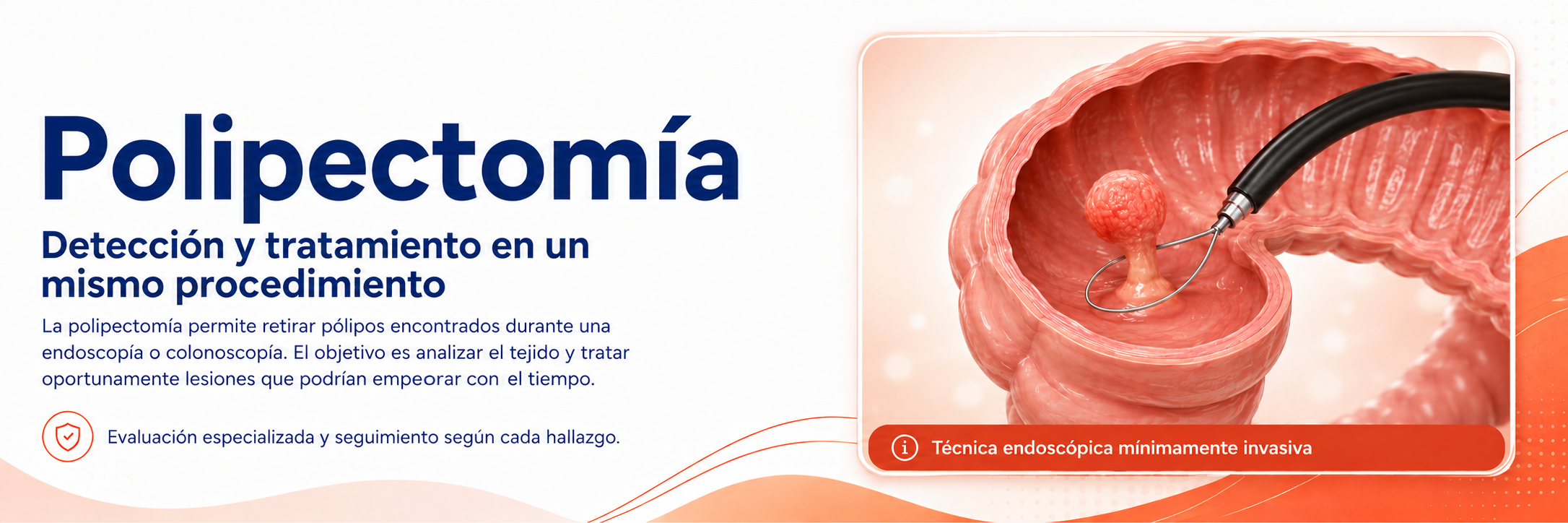 Polipectomía: detección y tratamiento en un mismo procedimiento