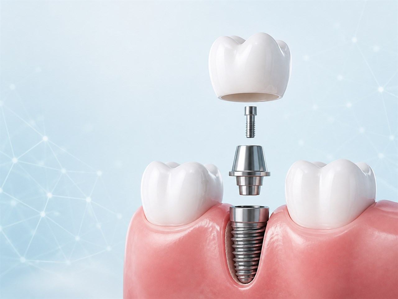 Componentes de un implante dental: corona, pilar e implante de titanio