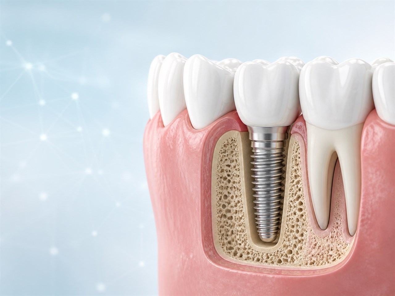 Implante dental integrado al hueso y terminado con una corona natural