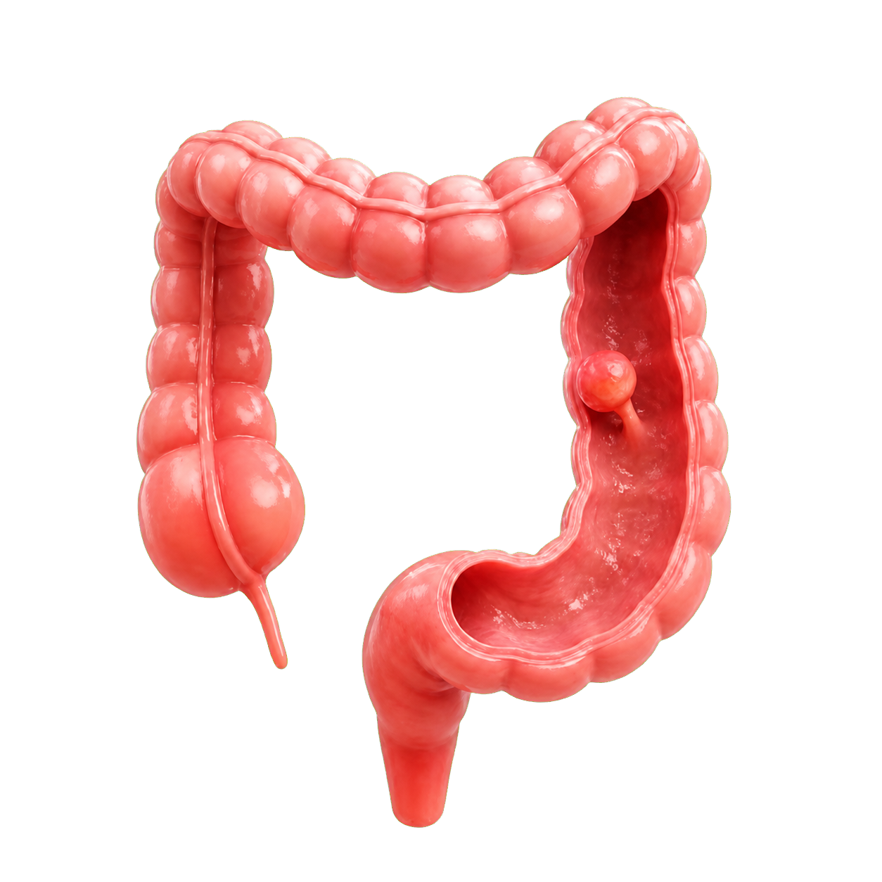 Pólipo detectado durante una evaluación del colon