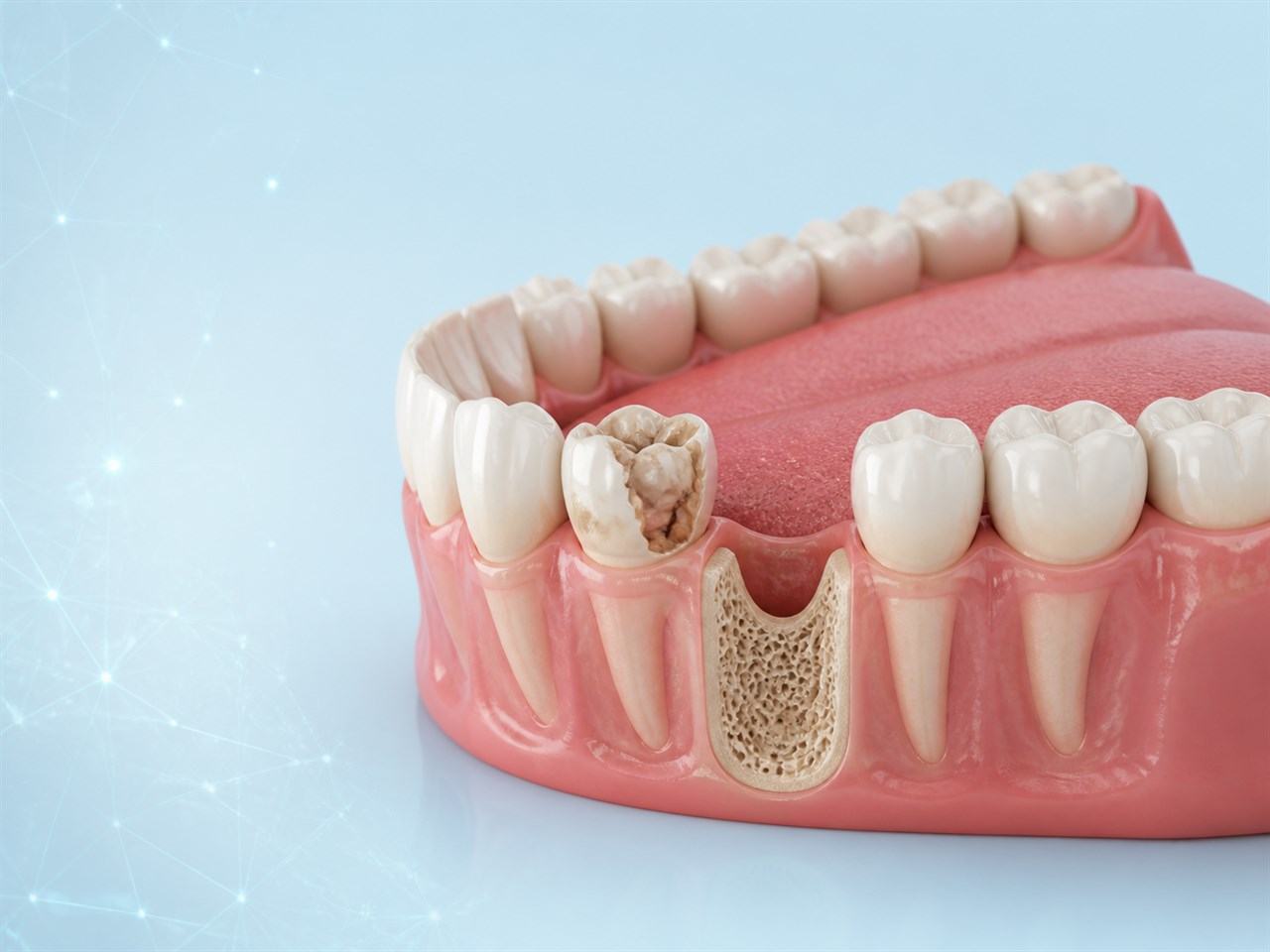 Modelo dental con una pieza ausente y un molar dañado