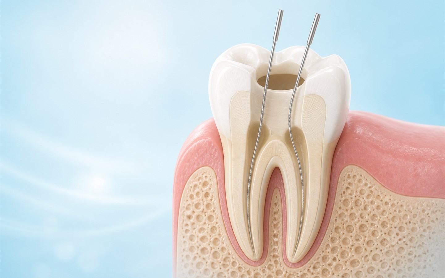 Molar durante la limpieza de sus conductos radiculares
