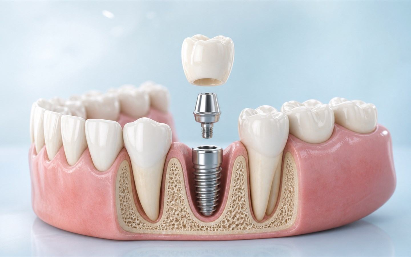 Modelo dental con implante y corona preparados para su instalación